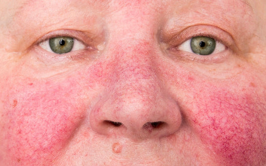 Rosacea Explained: Why Your Skin Flushes, Burns & Reacts