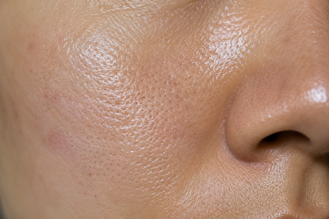 Oily Skin Explained: Why Your Skin Produces Excess Oil