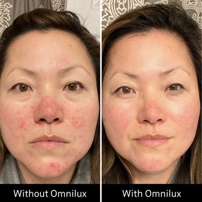 Omnilux Contour Face LED Mask + 3x Pack of Hydrogel Face Masks $629