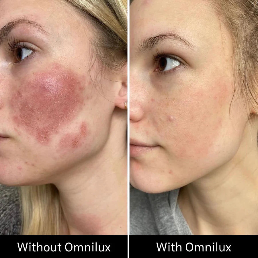 Omnilux Contour Face LED Mask + 3x Pack of Hydrogel Face Masks $629