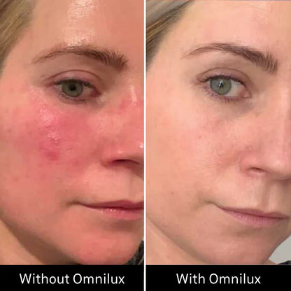 Omnilux Contour Face LED Mask + 3x Pack of Hydrogel Face Masks $629