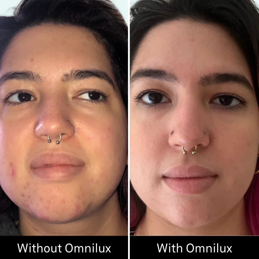 Omnilux Clear LED Mask + Hydrogel Mask Pack [3 Masks] $629.00