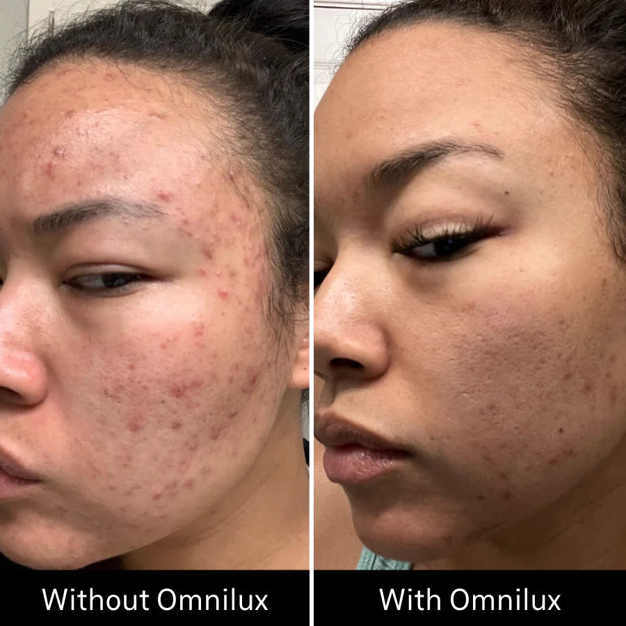 Omnilux Clear LED Mask + Hydrogel Mask Pack [3 Masks] $629.00